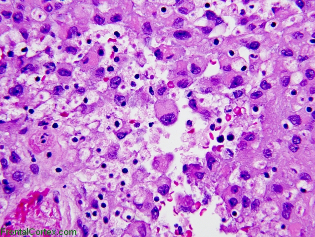 Rhabdoid meningioma, H&E stain x400